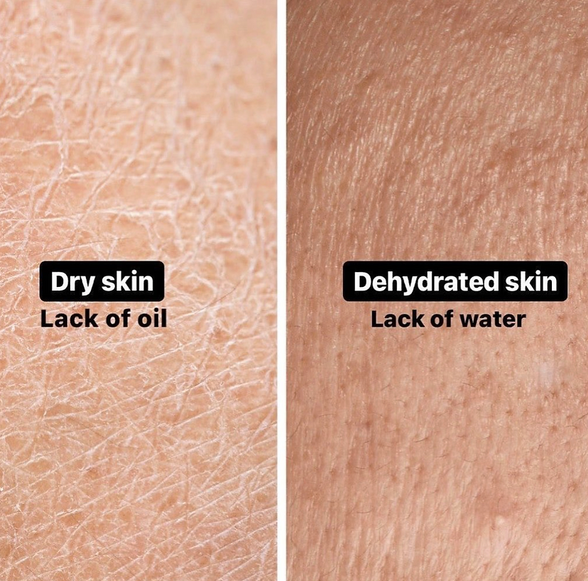 Do You Have Dry Skin or Dehydrated Skin?