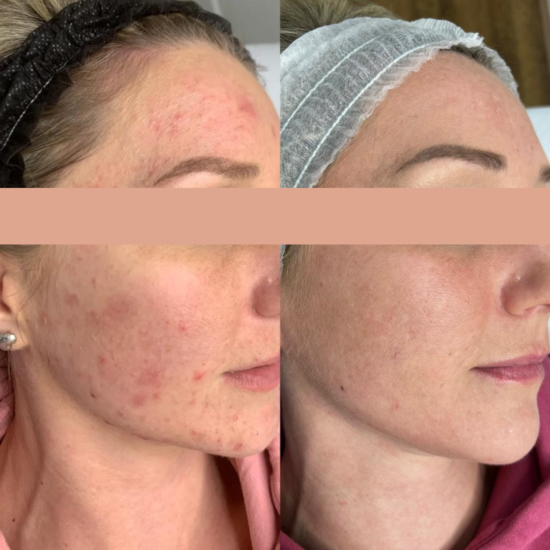 Skin Ripping Transformation Skin Transformation – Hannah Curlita Beauty