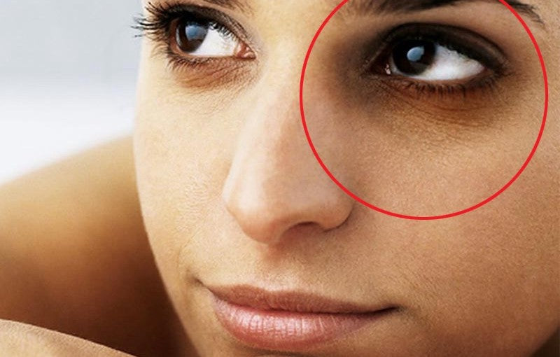 Dark Circles & How to Get Rid!