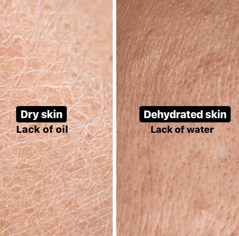 Do You Have Dry Skin or Dehydrated Skin? – Hannah Curlita Beauty