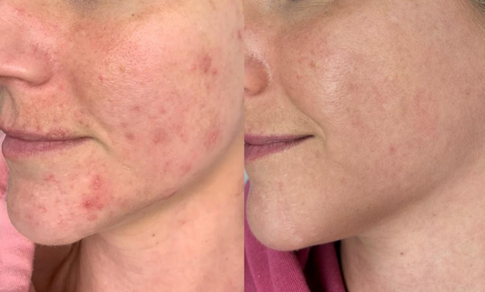 Achieve Clear Skin with Our Clinic's Acne Clearing Treatments